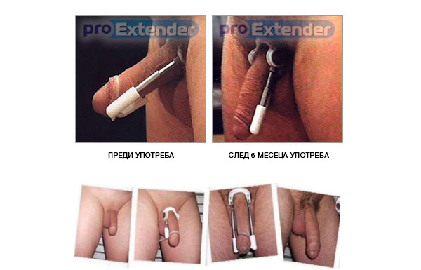 penis enlargement